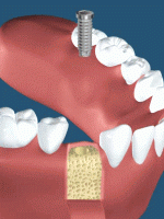 インプラントは根の部分の金属と歯の頭の被せる部分の両方に費用がかかる