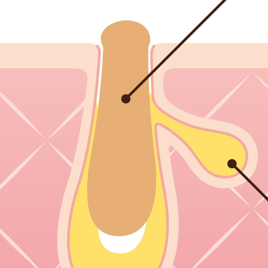 黒ずみ毛穴の原因と対策