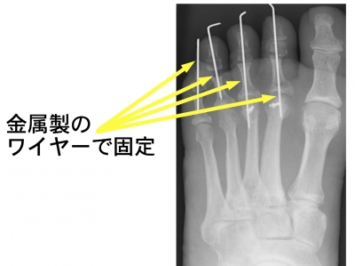 趾骨骨折手術 Dr Shui